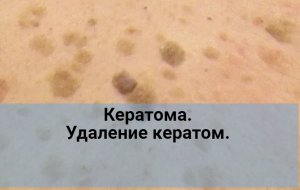 Кератома. Удаление кератом.
