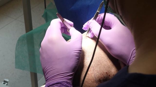 Przeszczep włosów, czyli ile wydałem i jak zostałem łysy смотреть онлайн