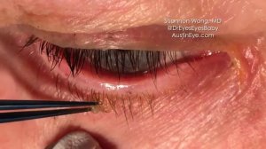 Удаление папилломы века