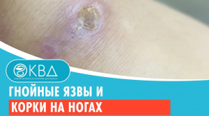 ?? Гнойные язвы и корки на ногах. Клинический случай №839