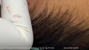 Big Cystic Acne Blackheads Extraction Blackheads & Milia, Whiteheads Removal Pimple Popping