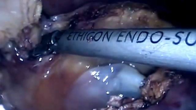 Laparoscopic surgery for Hydatid Cyst of the liver смотреть онлайн