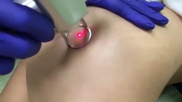 ❗️Удаление растяжек❗️ смотреть онлайн