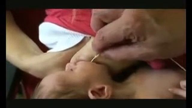 Dr. Jack Newman - Inserting A Lactation Aid