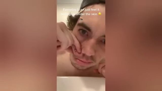 Popping huge blackheads and Pimple Popping - смотреть онлайн