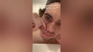 Popping huge blackheads and Pimple Popping -