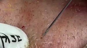 Relax squeezing out blackheads#5 Черные точки