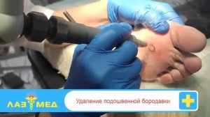Удаление подошвенной бородавки