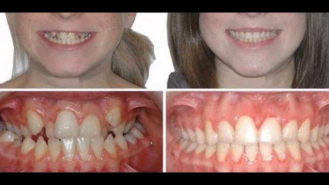 Брекеты До и после смотреть онлайн