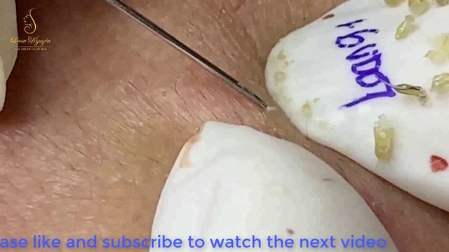 ACNE REMOVAL to have glowing skin care (91) |Loan Nguyen смотреть онлайн