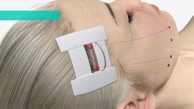 MINT - рассасывающаяся лифтинговая нить из PDO смотреть онлайн