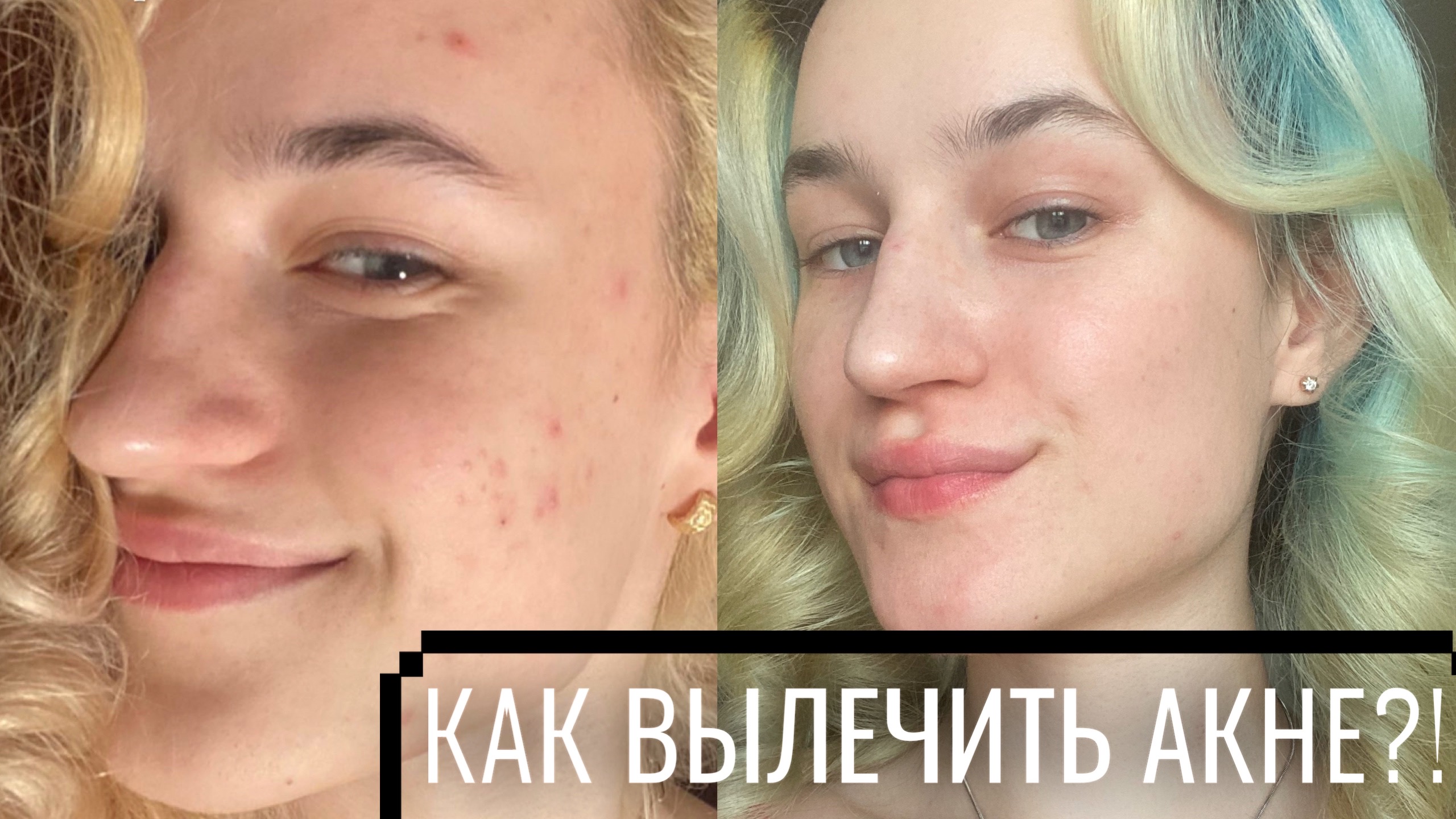 КАК ИЗБАВИТЬСЯ ОТ АКНЕ ЗА 2-3 МЕСЯЦА|ПОШАГОВОЕ ЛЕЧЕНИЕ АКНЕ И ПРЫЩЕЙ|СТОИМОСТЬ ПРОЦЕДУР И УХОДА смотреть онлайн