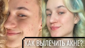 КАК ИЗБАВИТЬСЯ ОТ АКНЕ ЗА 2-3 МЕСЯЦА|ПОШАГОВОЕ ЛЕЧЕНИЕ АКНЕ И ПРЫЩЕЙ|СТОИМОСТЬ ПРОЦЕДУР И УХОДА