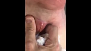 НОВОЕ ВИДЕО 2022  Прыщи давить залипательные