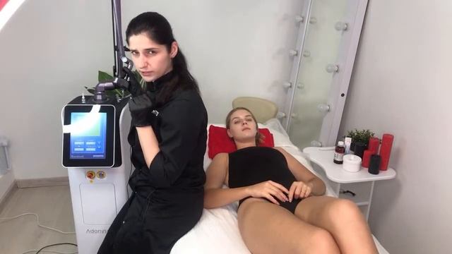 Удаление растяжек СО2 лазером смотреть онлайн