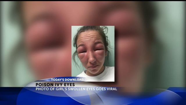 Girl gets poison ivy on eyes смотреть онлайн