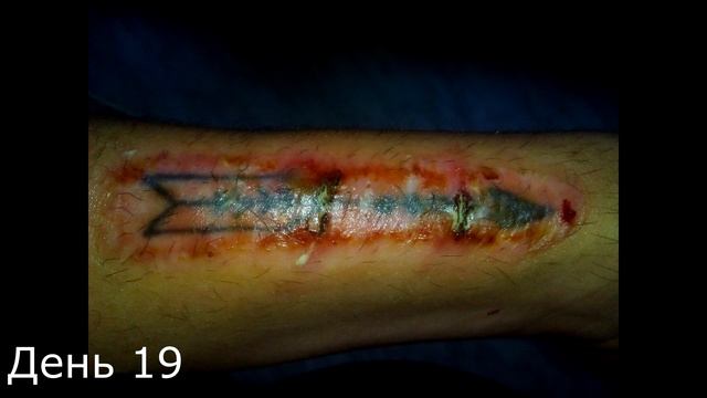 Выжигание татуировки йодом. 3 неделя. смотреть онлайн