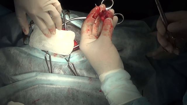 Резекционная артропластика ТБС смотреть онлайн