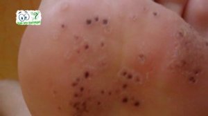 Шипица на руке и ноге. Причины и лечение. Бородавка, ВПЧ, как выглядит