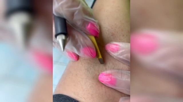 Что такое электроэпиляция. смотреть онлайн