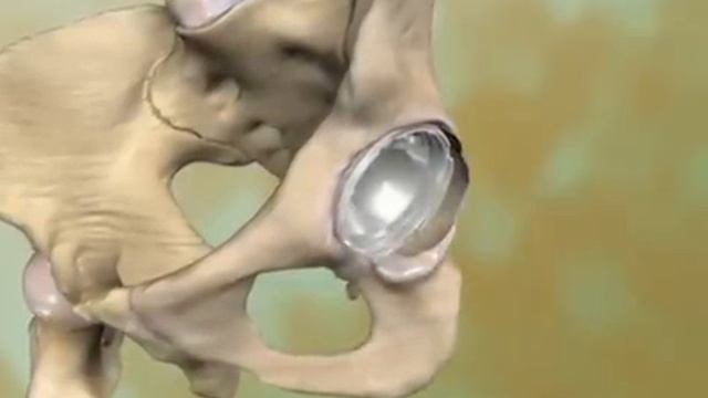Medical animation. Hip arthroplasty p.1 смотреть онлайн
