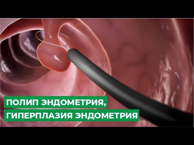 Полип эндометрия, гиперплазия эндометрия смотреть онлайн