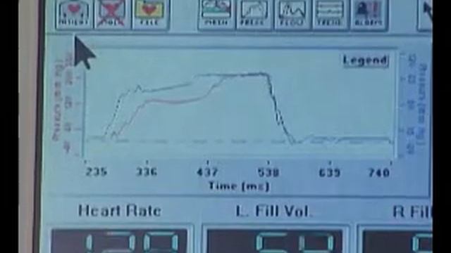 10. Artificial Heart: How are ejection and filling monitored in the Total Artificial Heart? смотреть онлайн