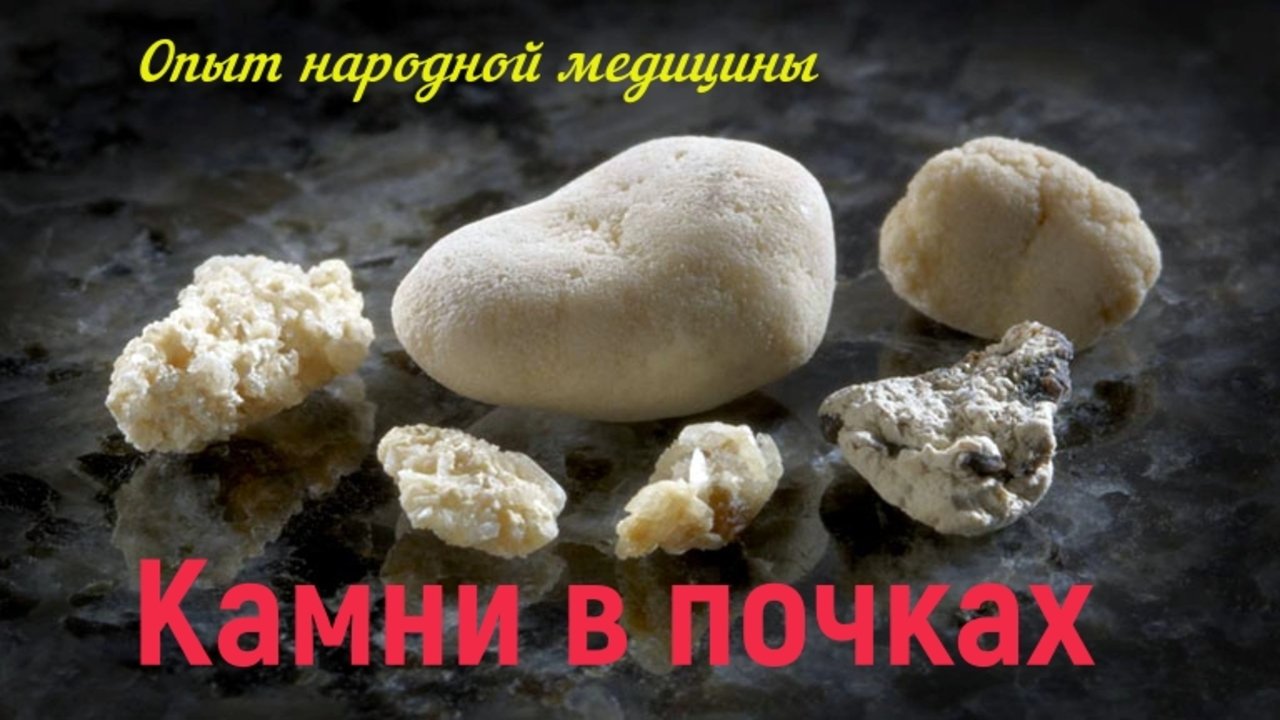Камни в почках. Как избавится.. смотреть онлайн