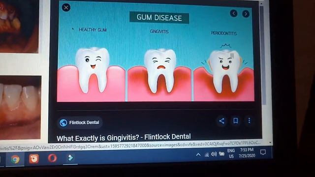 GASTROINTESTINAL TRACT PATHOLOGY lecture1 TEETH and APHTHOUS ULCERS verry IMPORTANT смотреть онлайн