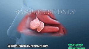 Полипы в носу. Лечение. Причины.Симптомы