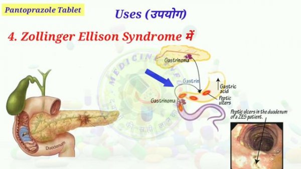 Pantoprazole | Pantocid | Pantop 40 | Pantoprazole uses | Pantoprazole 40 mg | Uses | Side effect