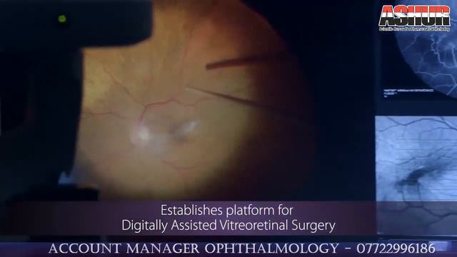 Alcon NGENUITY 3D Visualization System - DATAFUSION to simplify and customize vitreoretinal surgery смотреть онлайн