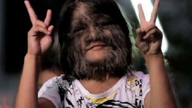 Девушка с синдромом оборотня впервые состригла волосы с лица. Потому что выходит замуж! смотреть онлайн