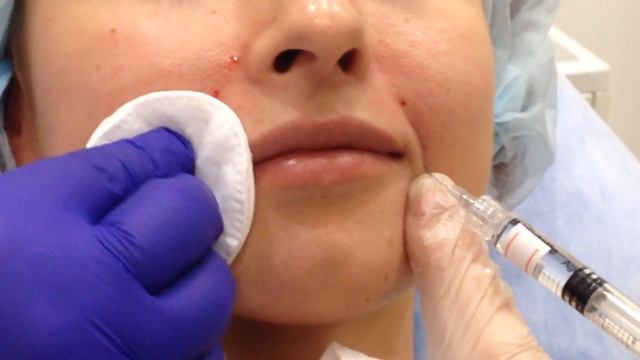 АирисКом: практика студентов. заполнение НОСОГУБНОЙ СКЛАДКИ филлером