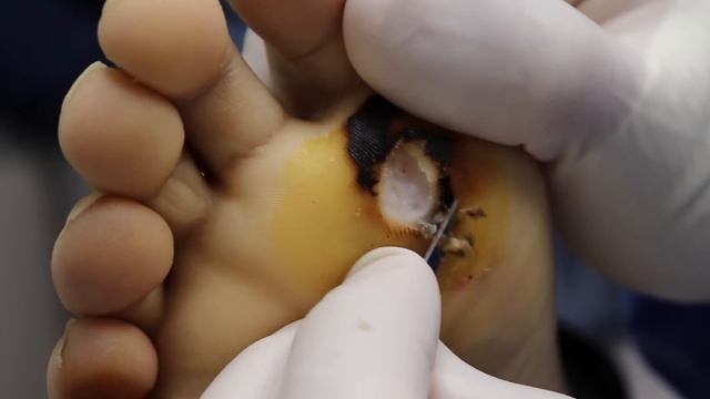 A PRETTY PLANTAR WART?! ***CUTTING OUT A HUGE FOOT WART*** смотреть онлайн