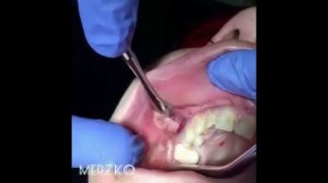 УДАЛЕНИЕ ГНОЯ С ПОЛОСТИ РТА. (18+)