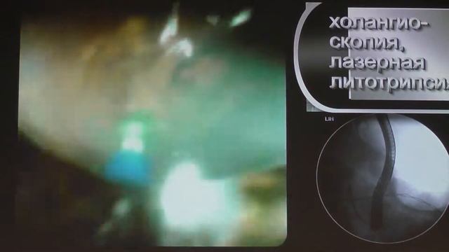 05 Бахтиозина ДВ Эндоскопическая диагностика и лечение сложного рецидивного холедохолитиаза смотреть онлайн