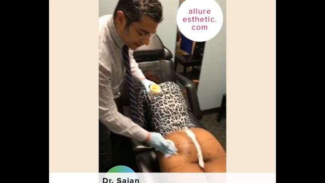 Non-Surgical Brazilian Butt Lift with Filler смотреть онлайн