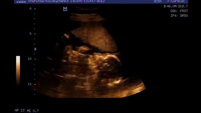 узи 14 и 22 недели ,Тимурка смотреть онлайн