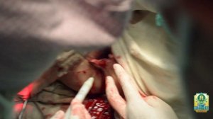 Лазерная геморроидэктомия. Наружный геморрой. ДНМУ г. Дружковка Hemorrhoidectomy