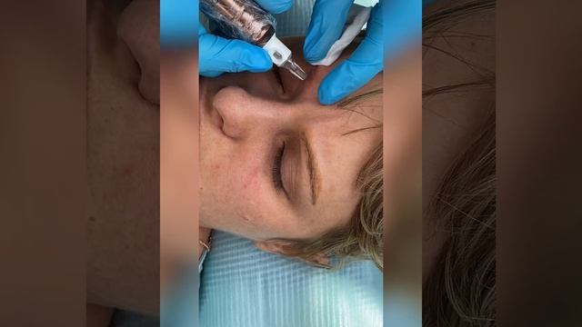 Удаление татуажа бровей ремувером смотреть онлайн