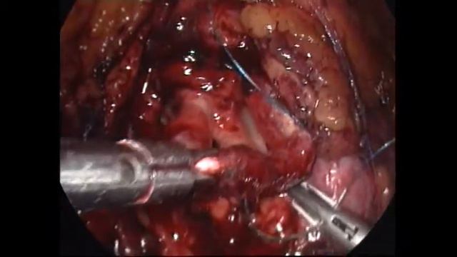 Laparoscopic Pyeloplasty_20160303