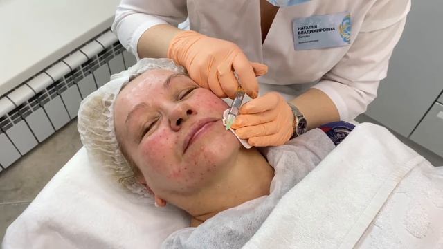 Биоревитализация Revi Strong