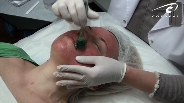 Можно ли делать нидлинг летом смотреть онлайн