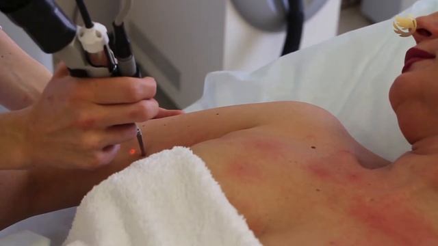 УДАЛЕНИЕ СОСУДОВ смотреть онлайн