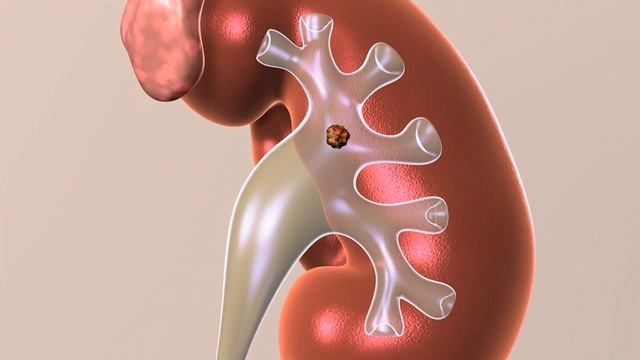 Shockwave Lithotripsy