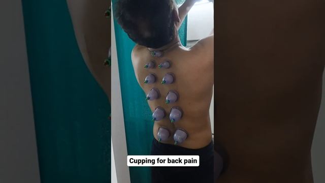 cupping for back pain смотреть онлайн