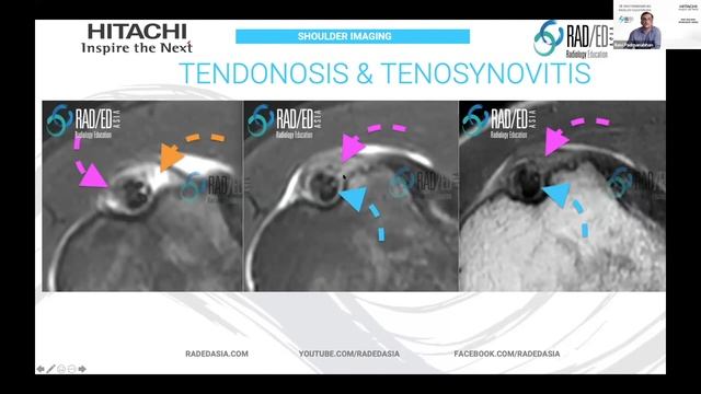 MRI Online Review Learn MSK MRI Radiology : MRI Shoulder MRI Biceps Tendonosis and Tenosynovitis смотреть онлайн