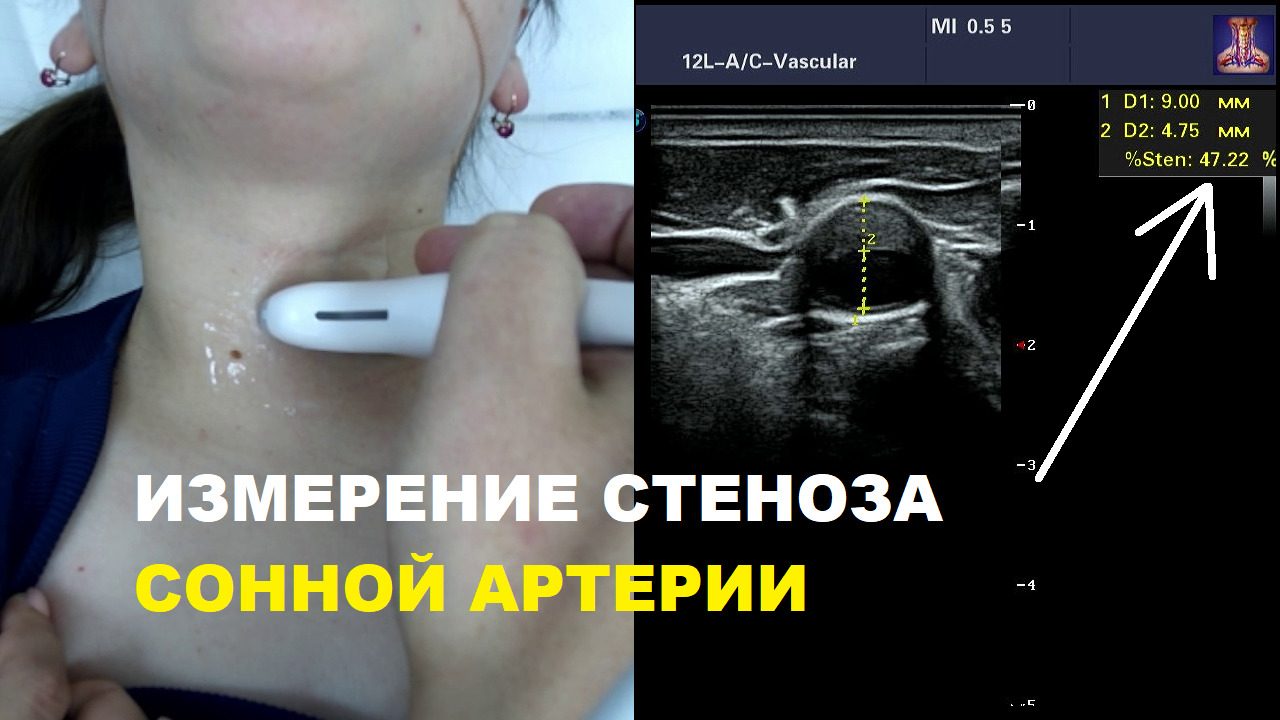 Как измерить СТЕНОЗ сонной артерии на УЗИ? смотреть онлайн