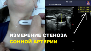 Как измерить СТЕНОЗ сонной артерии на УЗИ?